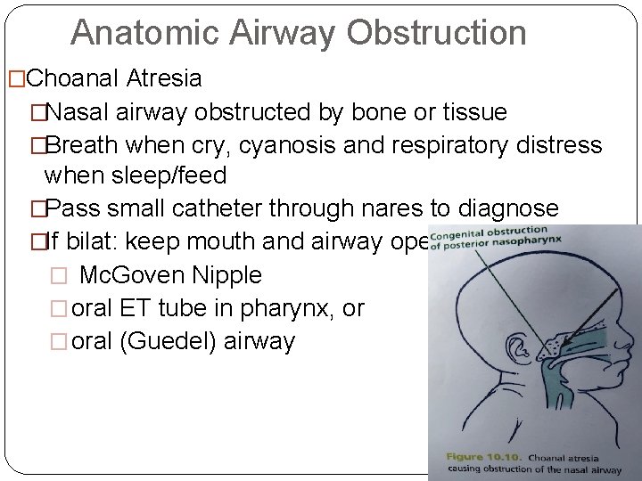 Anatomic Airway Obstruction �Choanal Atresia �Nasal airway obstructed by bone or tissue �Breath when