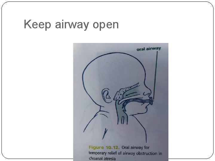 Keep airway open 