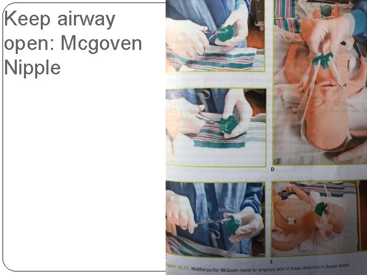 Keep airway open: Mcgoven Nipple 