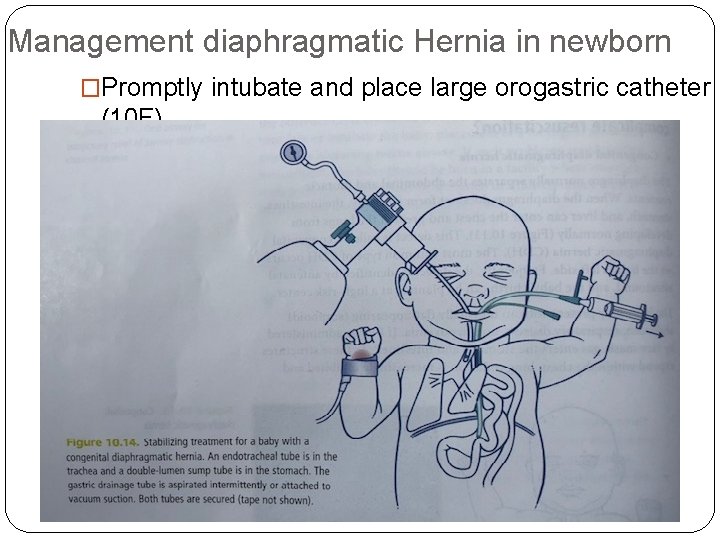 Management diaphragmatic Hernia in newborn �Promptly intubate and place large orogastric catheter (10 F)