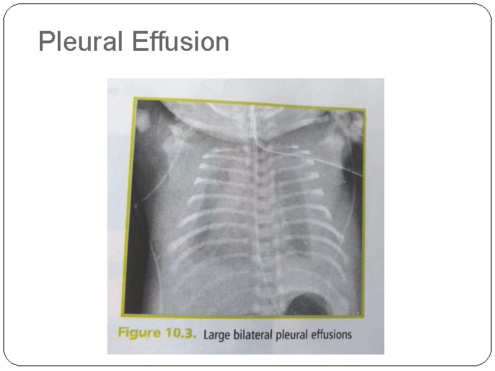 Pleural Effusion 