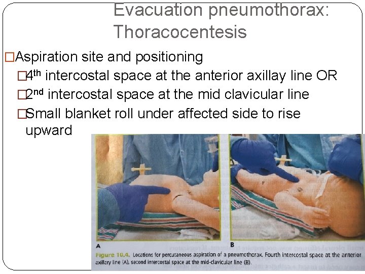 Evacuation pneumothorax: Thoracocentesis �Aspiration site and positioning � 4 th intercostal space at the