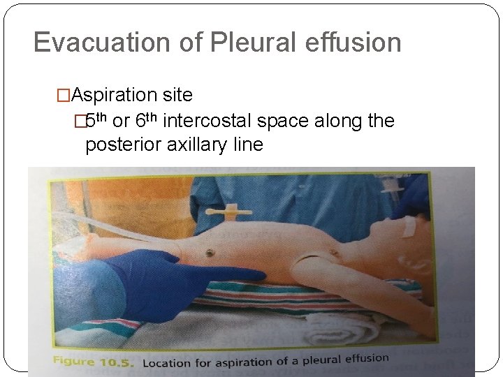 Evacuation of Pleural effusion �Aspiration site � 5 th or 6 th intercostal space