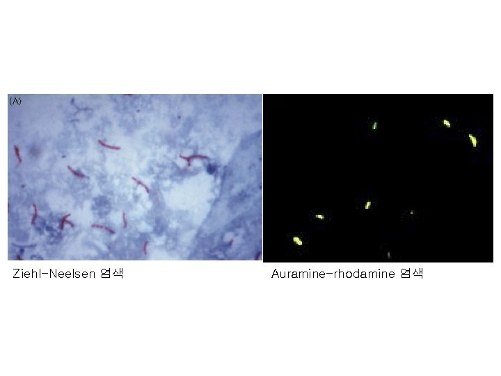 Ziehl-Neelsen 염색 Auramine-rhodamine 염색 