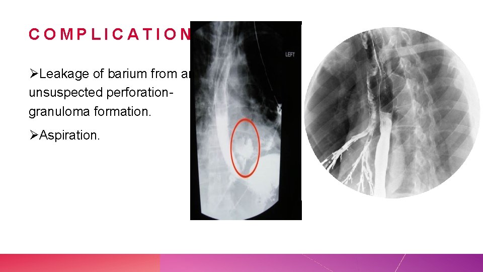 COMPLICATIONS ØLeakage of barium from an unsuspected perforationgranuloma formation. ØAspiration. 