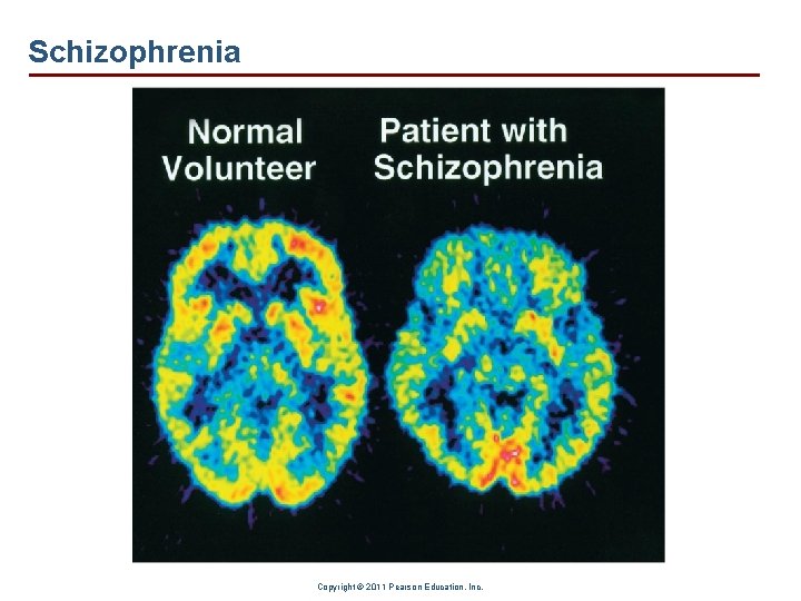 Schizophrenia Copyright © 2011 Pearson Education, Inc. 