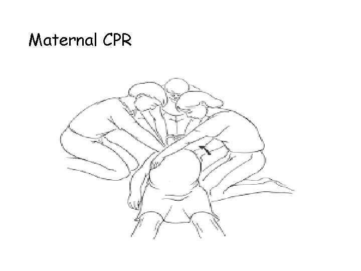 Maternal CPR 