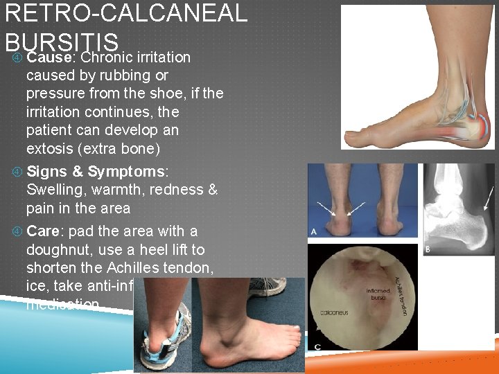 RETRO-CALCANEAL BURSITIS Cause: Chronic irritation caused by rubbing or pressure from the shoe, if