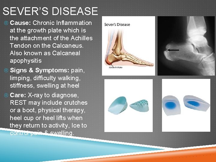 SEVER’S DISEASE Cause: Chronic Inflammation at the growth plate which is the attachment of