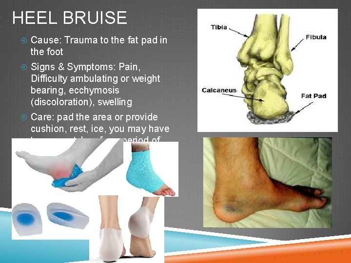 HEEL BRUISE Cause: Trauma to the fat pad in the foot Signs & Symptoms: