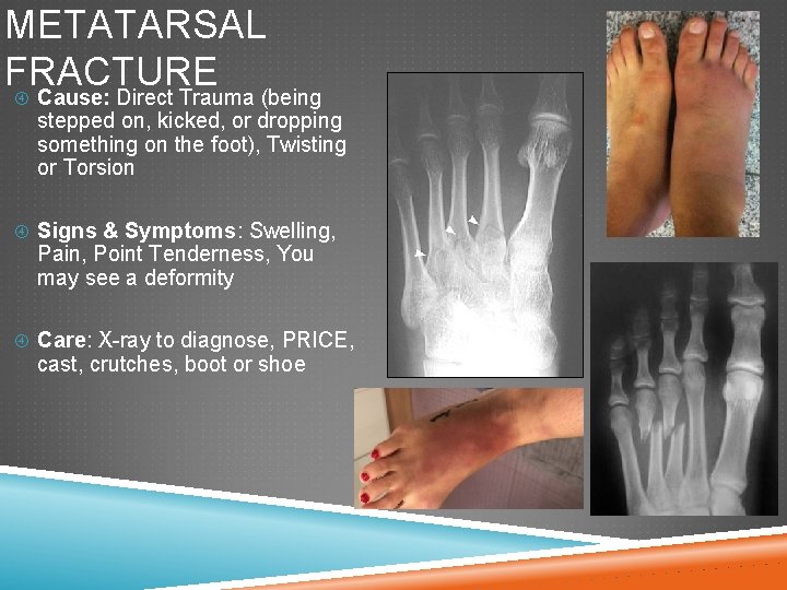 METATARSAL FRACTURE Cause: Direct Trauma (being stepped on, kicked, or dropping something on the