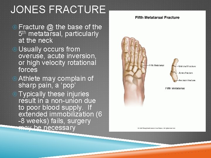 JONES FRACTURE Fracture @ the base of the 5 th metatarsal, particularly at the