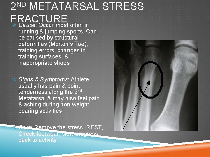 2 ND METATARSAL STRESS FRACTURE Cause: Occur most often in running & jumping sports.