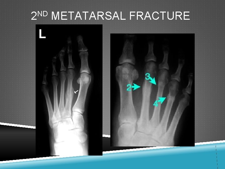 2 ND METATARSAL FRACTURE 
