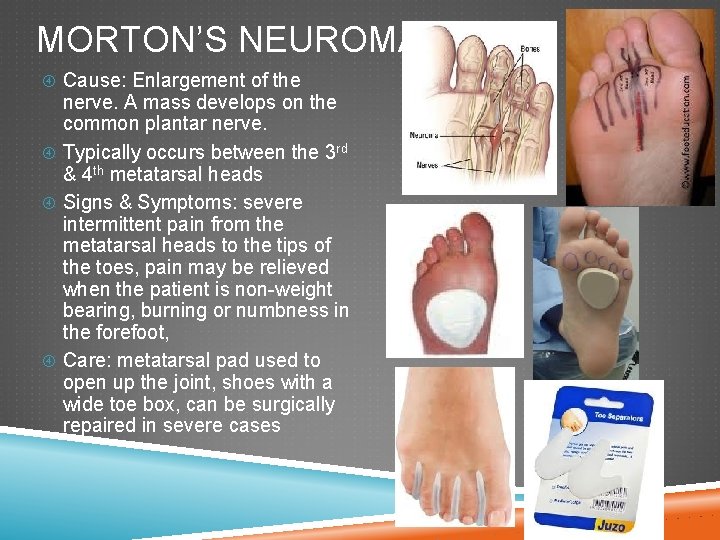 MORTON’S NEUROMA Cause: Enlargement of the nerve. A mass develops on the common plantar