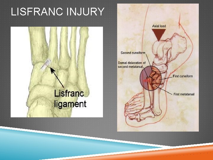 LISFRANC INJURY 