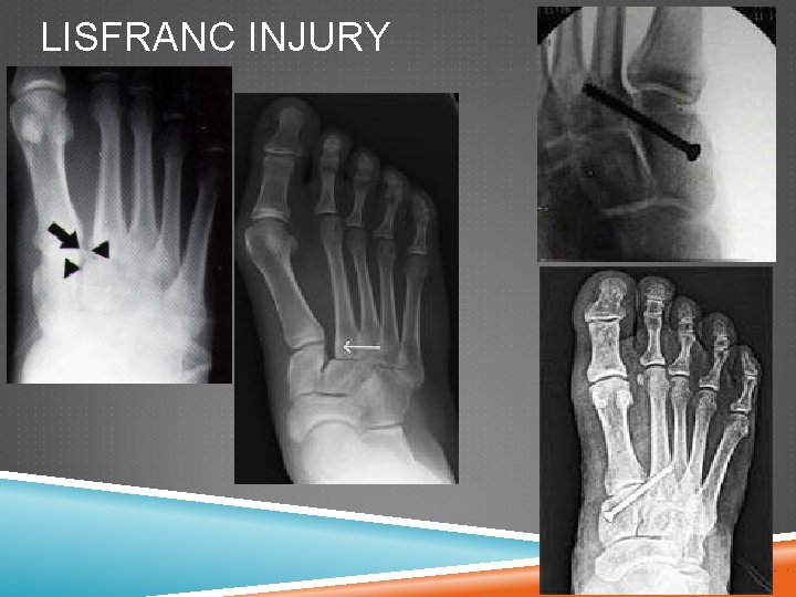 LISFRANC INJURY 