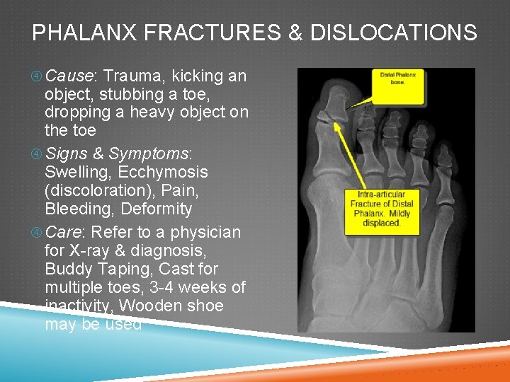 PHALANX FRACTURES & DISLOCATIONS Cause: Trauma, kicking an object, stubbing a toe, dropping a