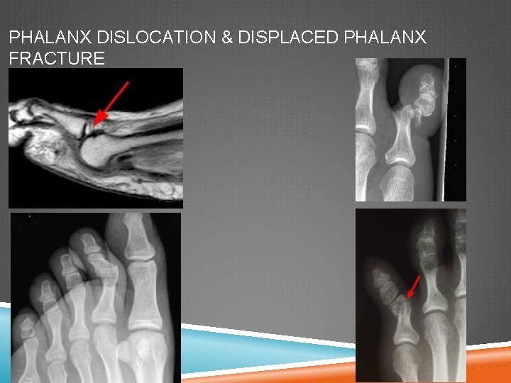 PHALANX DISLOCATION & DISPLACED PHALANX FRACTURE 