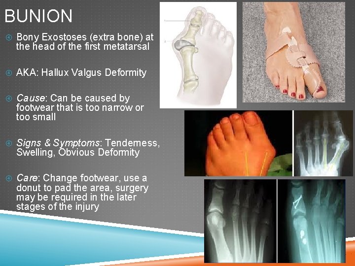 BUNION Bony Exostoses (extra bone) at the head of the first metatarsal AKA: Hallux