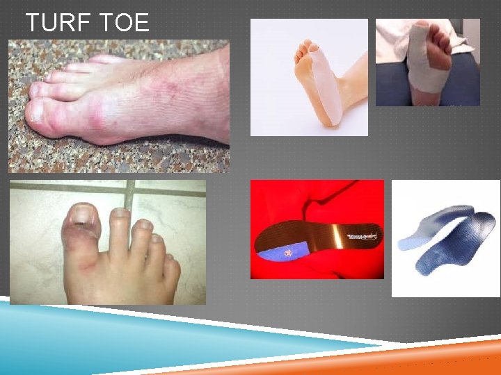 TURF TOE 