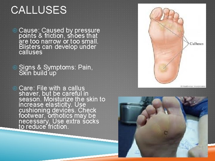 CALLUSES Cause: Caused by pressure points & friction, shoes that are too narrow or