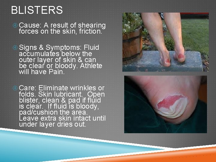 BLISTERS Cause: A result of shearing forces on the skin, friction. Signs & Symptoms: