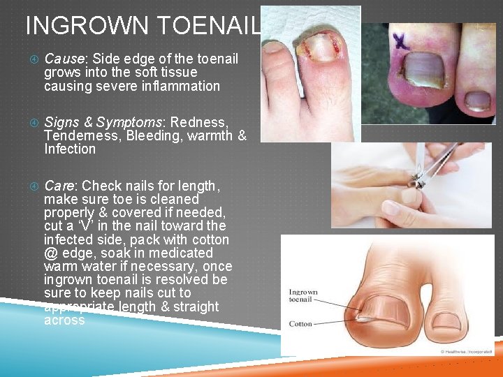 INGROWN TOENAIL Cause: Side edge of the toenail grows into the soft tissue causing