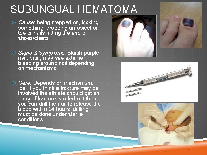 SUBUNGUAL HEMATOMA Cause: being stepped on, kicking something, dropping an object on toe or