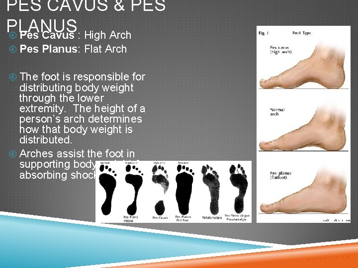 PES CAVUS & PES PLANUS Pes Cavus : High Arch Pes Planus: Flat Arch