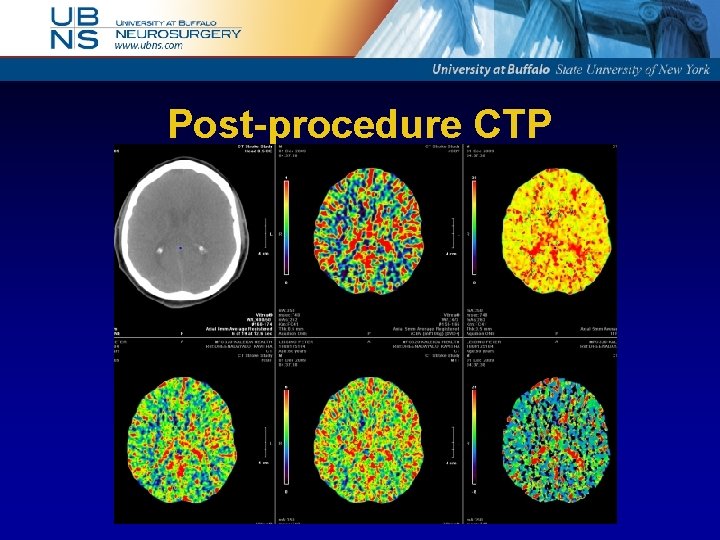 Post-procedure CTP 