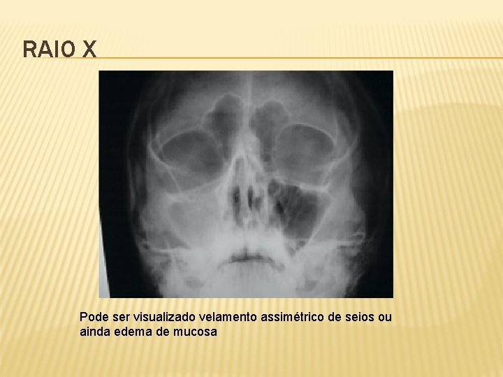 RAIO X Pode ser visualizado velamento assimétrico de seios ou ainda edema de mucosa