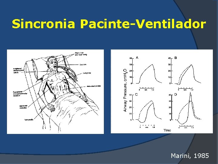 Sincronia Pacinte-Ventilador Marini, 1985 