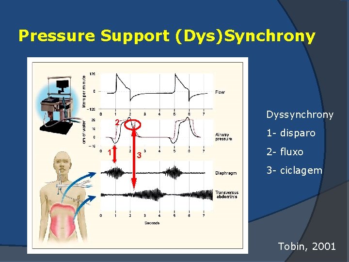 Pressure Support (Dys)Synchrony Dyssynchrony 2 1 1 - disparo 3 2 - fluxo 3