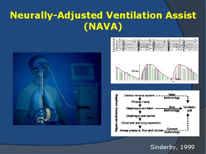 Neurally-Adjusted Ventilation Assist (NAVA) Sinderby, 1999 