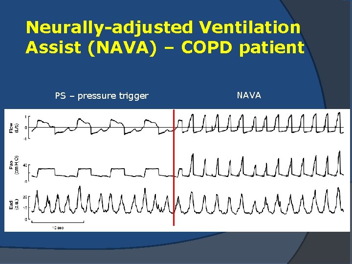 Neurally-adjusted Ventilation Assist (NAVA) – COPD patient PS – pressure trigger NAVA 