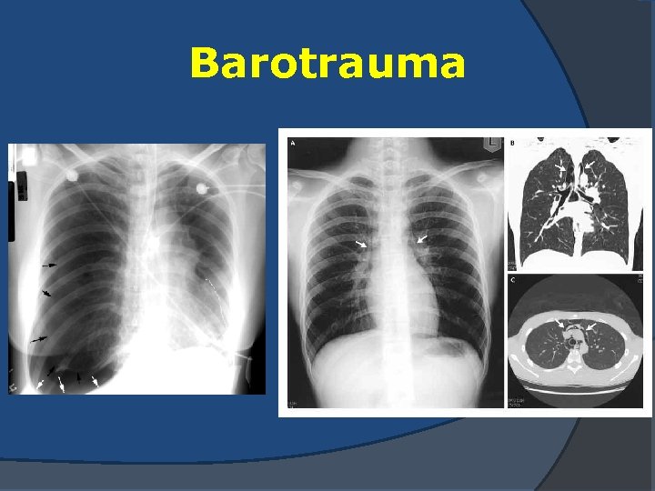 Barotrauma 