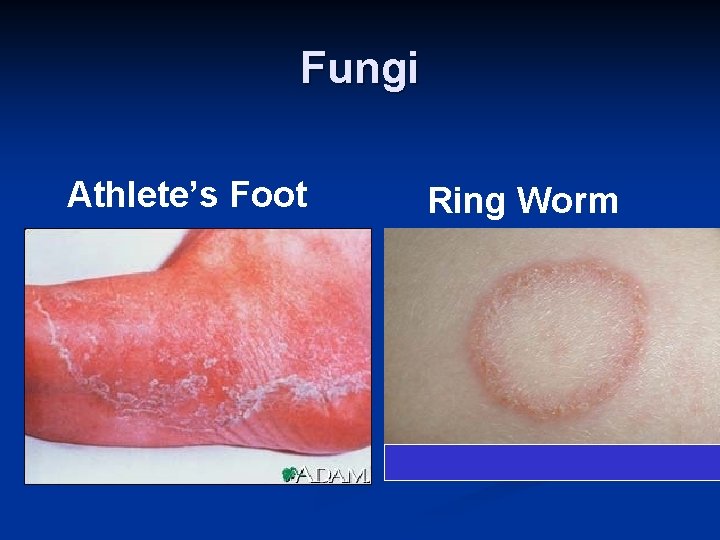 Fungi Athlete’s Foot Ring Worm 