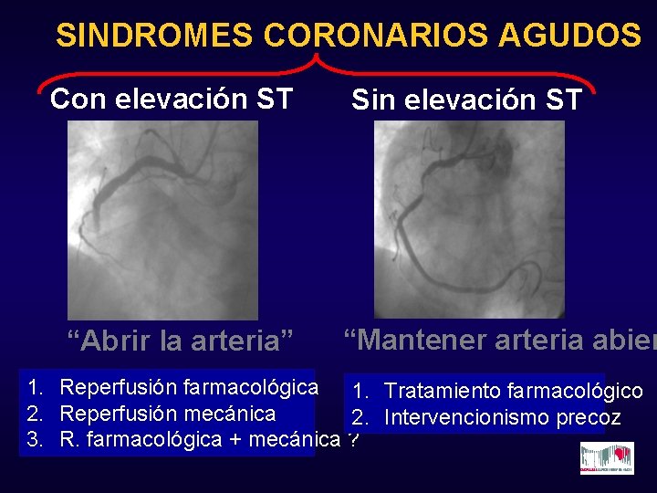 SINDROMES CORONARIOS AGUDOS Con elevación ST “Abrir la arteria” Sin elevación ST “Mantener arteria