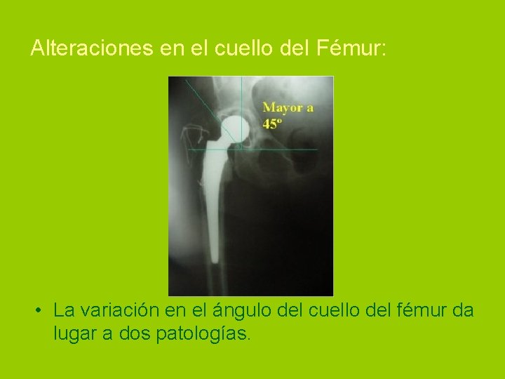 Alteraciones en el cuello del Fémur: • La variación en el ángulo del cuello