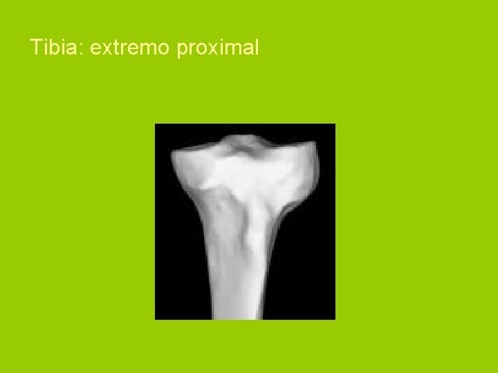 Tibia: extremo proximal 