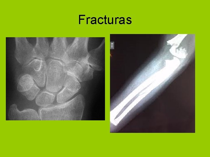 Fracturas 