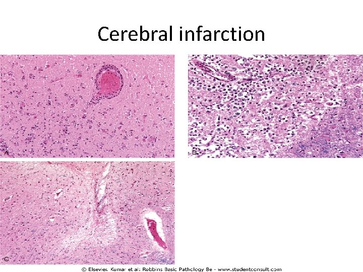 Cerebral infarction 