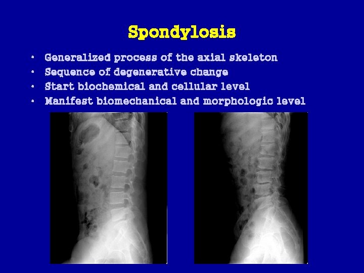Spondylosis • • Generalized process of the axial skeleton Sequence of degenerative change Start