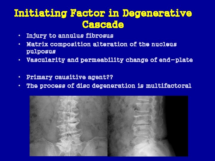 Initiating Factor in Degenerative Cascade • Injury to annulus fibrosus • Matrix composition alteration