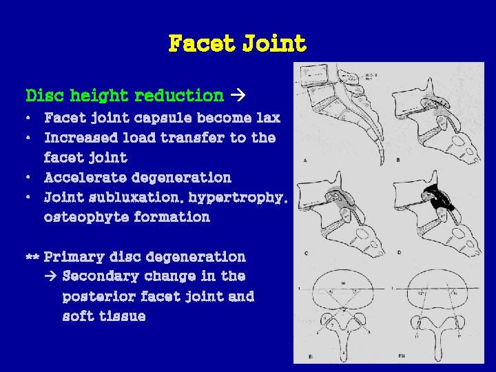 Facet Joint Disc height reduction • Facet joint capsule become lax • Increased load