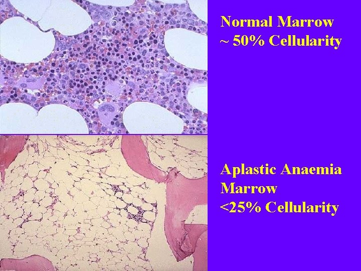 Normal Marrow ~ 50% Cellularity Aplastic Anaemia Marrow <25% Cellularity 