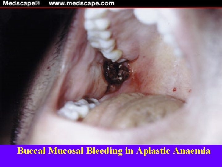 Buccal Mucosal Bleeding in Aplastic Anaemia 