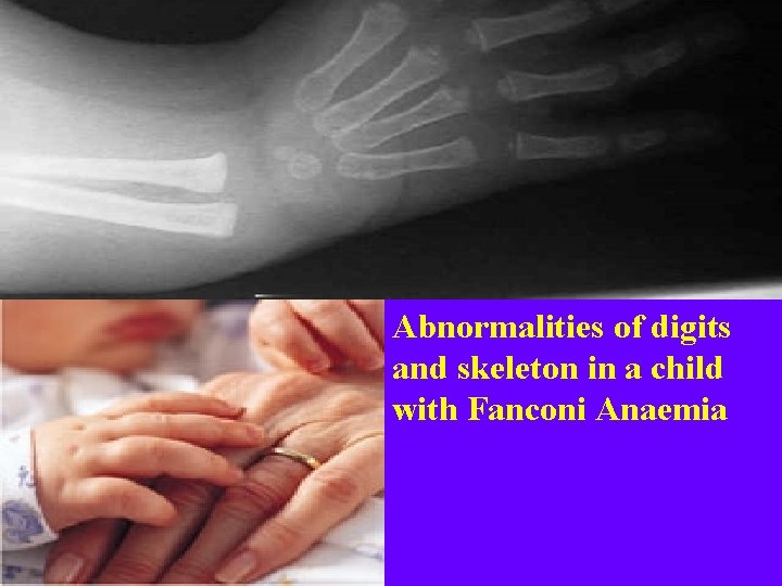 Abnormalities of digits and skeleton in a child with Fanconi Anaemia 