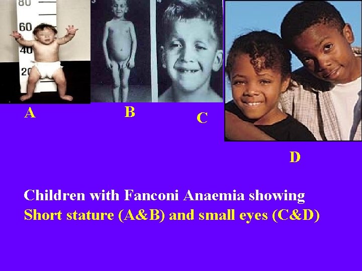 A B C D Children with Fanconi Anaemia showing Short stature (A&B) and small